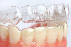Aparelho dental Invisalign em Ibaiti