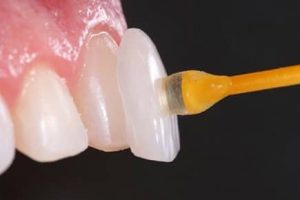 Lente Dental em Ibaiti
