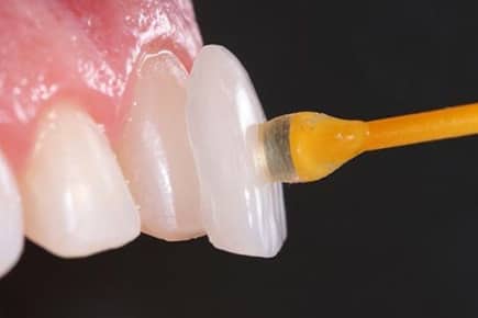 Lente Dental em Ibaiti